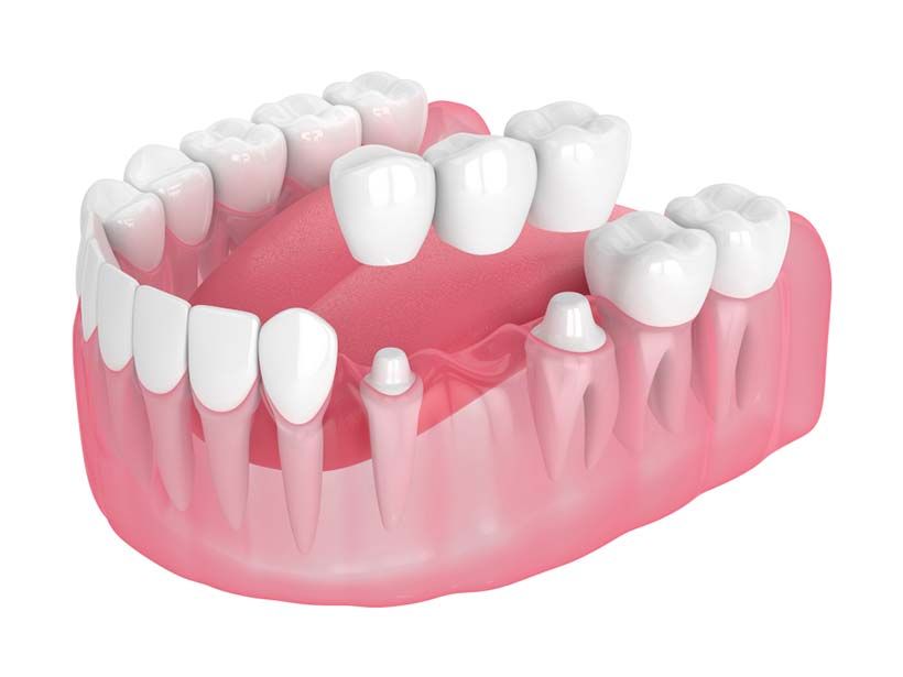 Affordable Dental Bridges with