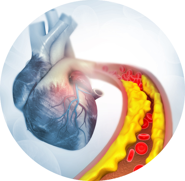 HYPERCHOLESTEROLEMIA