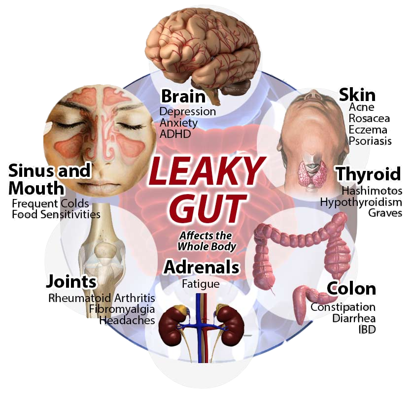 Leaky Gut